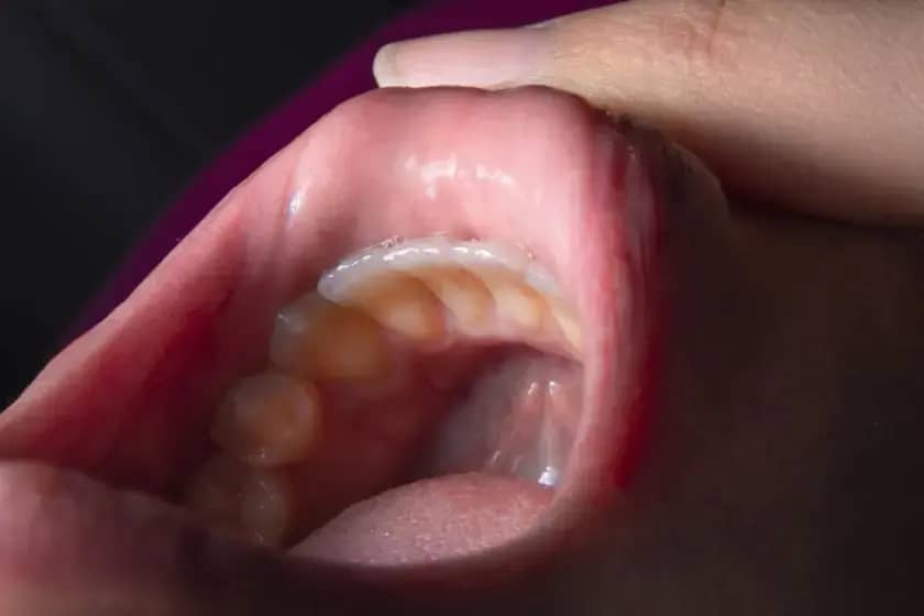 Epiglotitis: Hitni simptomi, bol u grlu i otežano disanje – kako prepoznati i odmah reagovati