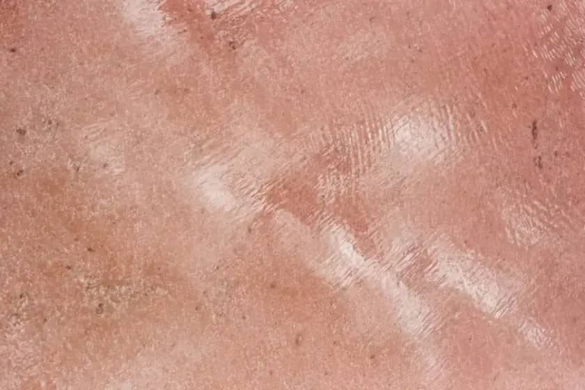 Kontaktni dermatitis: simptomi, uzroci i najbolje liječenje za osip i intenzivan svrab