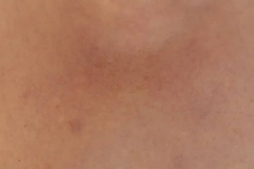 Oticanje lica: Uzroci, simptomi i hitno liječenje angioedema i anafilaksije