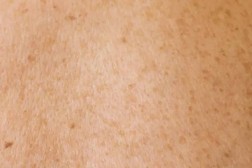 Aktinična keratoza: Kako prepoznati simptome, liječenje i spriječiti rak kože