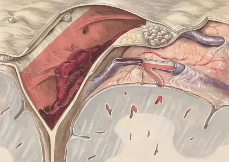 Femoralna arterija: simptomi blokade, periferna arterijska bolest, testovi i liječenje koje morate znati