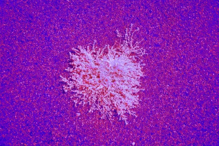 Adenokarcinom: Simptomi, stadijumi, liječenje i metastaze koje morate prepoznati