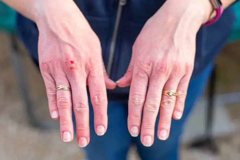 Furnijeova gangrena: simptomi, uzroci i hitno liječenje koje spašava život