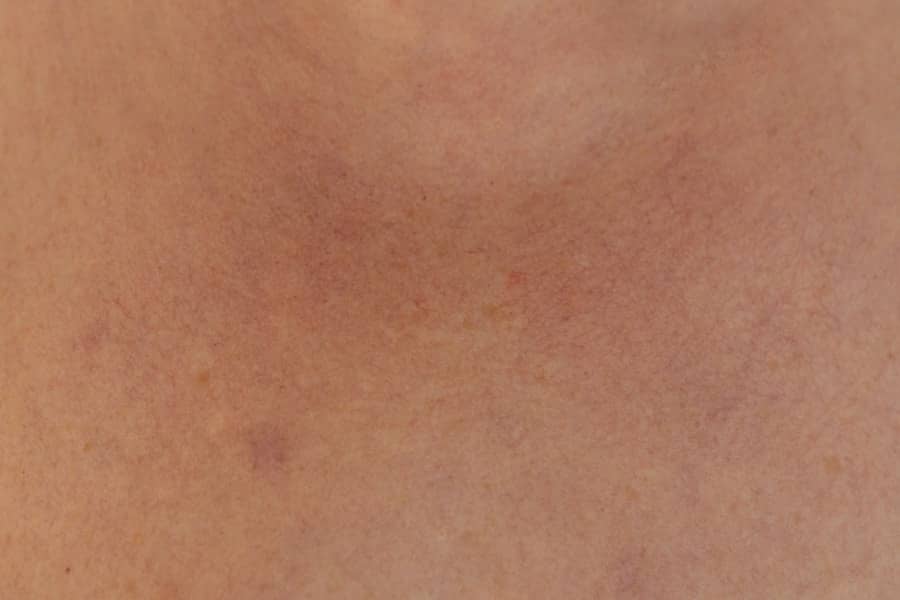 Oticanje lica: Uzroci, simptomi i hitno liječenje angioedema i anafilaksije