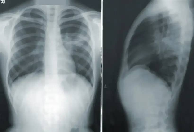 Sve što trebate znati o pneumoniji: simptomi, uzroci i lečenje