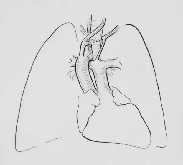 Uvećanje hiluma pluća: simptomi, uzroci (rak pluća, limfadenopatija) i kako CT i PET pomažu u dijagnozi