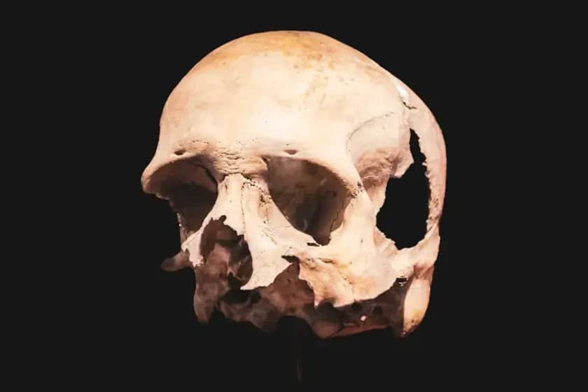 Rekonstrukcija lobanje 3D štampom i titanijumskim implantima: Neverovatan oporavak nakon strašnog pada