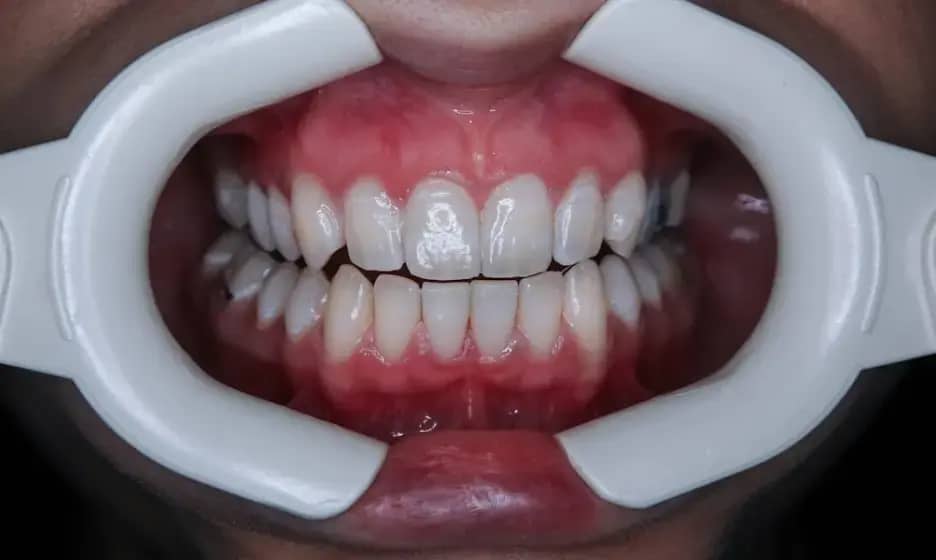 Bol u ustima: Uzroci, simptomi i kada zabrinuti — afte, herpes, suva usta i oralni karcinom
