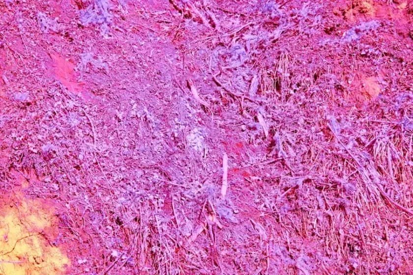 Švanom - tumor nerava: simptomi, dijagnoza i najbolje lečenje vestibularnog švanoma