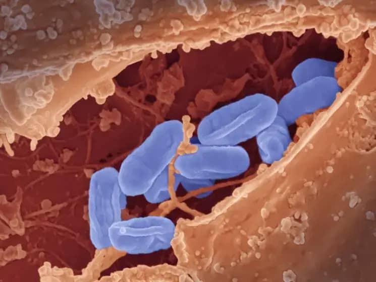 Trbušni tifus i tifus otporan na antibiotike: Simptomi, vrste tifusa i kako se širi