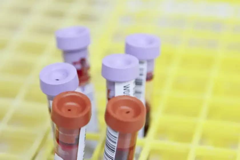 4 ključne analize posle 40: lipidni profil, HDL/LDL, kreatinin i HbA1c za prevenciju srčanih bolesti