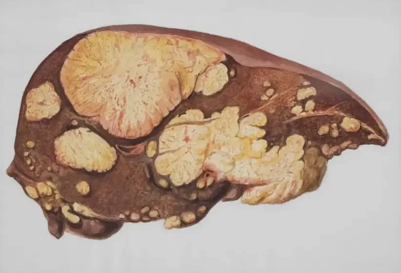 Insulinom: Retki tumor pankreasa koji može ozbiljno ugroziti zdravlje