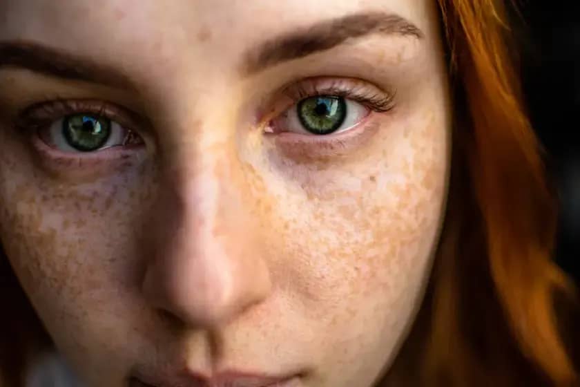 Melazma: Kako prepoznati i efikasno tretirati ‘brkove od sunca’ uz savjete dermatologa