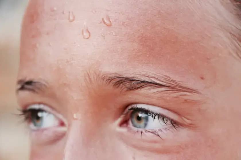 Kako anhidroza utiče na vaše zdravlje: simptomi, uzroci i mere zaštite