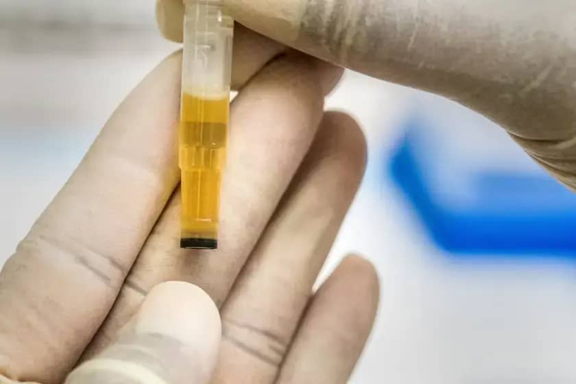 Uzroci i simptomi eritrocita u urinu: Kada promjene boje mokraće upozoravaju na ozbiljne bolesti
