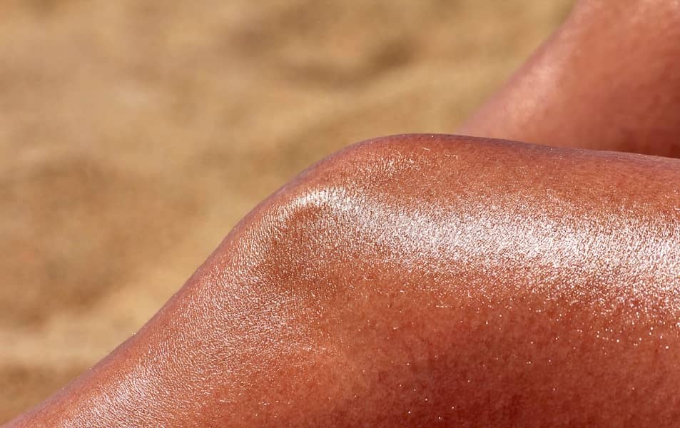Kako prepoznati i liječiti trovanje suncem: simptomi teških opekotina i sistemske reakcije