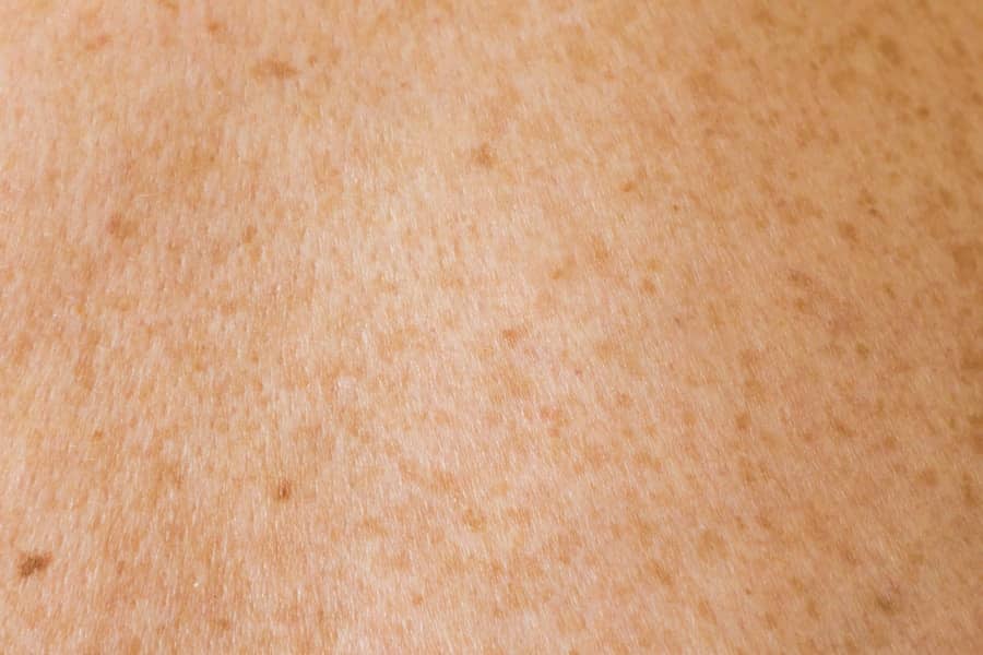 Sve o celulitu: Kako prepoznati, šta ga uzrokuje i najučinkovitije metode tretmana sa ultraformer III tehnologijom
