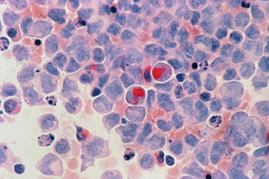 Leukemija kutis: Prepoznajte Kožne Lezije i Simptome Koji Ukazuju na Ovaj Retki Tip Leukemije