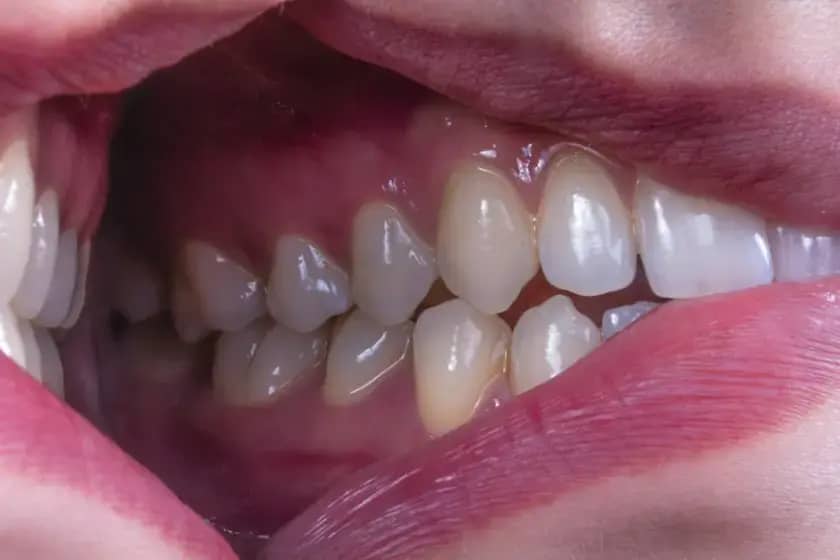 Gingivitis ili paradentoza? Otkrivamo glavne razlike, simptome, lečenje i prevenciju bolesti desni