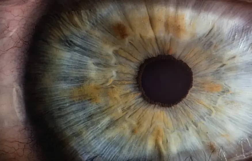 Keratokonjunktivitis: Simptomi, uzroci i lečenje — rizik kod kontaktnih sočiva i kako sačuvati vid